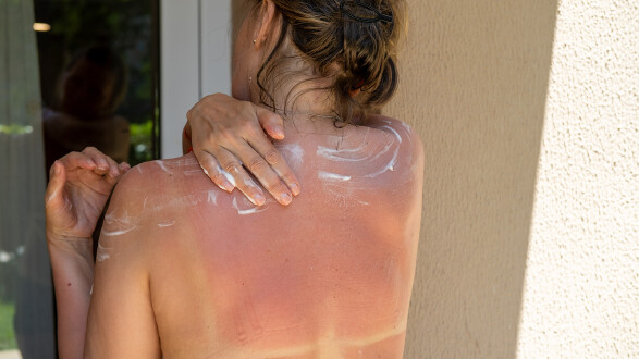 Nahaufnahme einer Frau von hinten, die ihre Hand &uuml;ber den R&uuml;cken greift, um wei&szlig;e Sonnencreme auf der stark ger&ouml;teten Haut ihres sonnenverbrannten R&uuml;ckens zu verteilen.