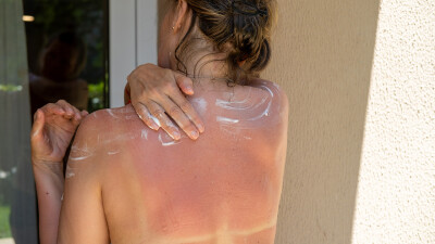 Nahaufnahme einer Frau von hinten, die ihre Hand &uuml;ber den R&uuml;cken greift, um wei&szlig;e Sonnencreme auf der stark ger&ouml;teten Haut ihres sonnenverbrannten R&uuml;ckens zu verteilen.