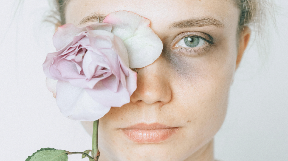 Frau mit blauem Auge und Rose vor dem Gesicht © pexels-nataliya-vaitkevich