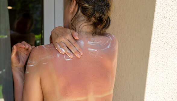 Nahaufnahme einer Frau von hinten, die ihre Hand &uuml;ber den R&uuml;cken greift, um wei&szlig;e Sonnencreme auf der stark ger&ouml;teten Haut ihres sonnenverbrannten R&uuml;ckens zu verteilen.